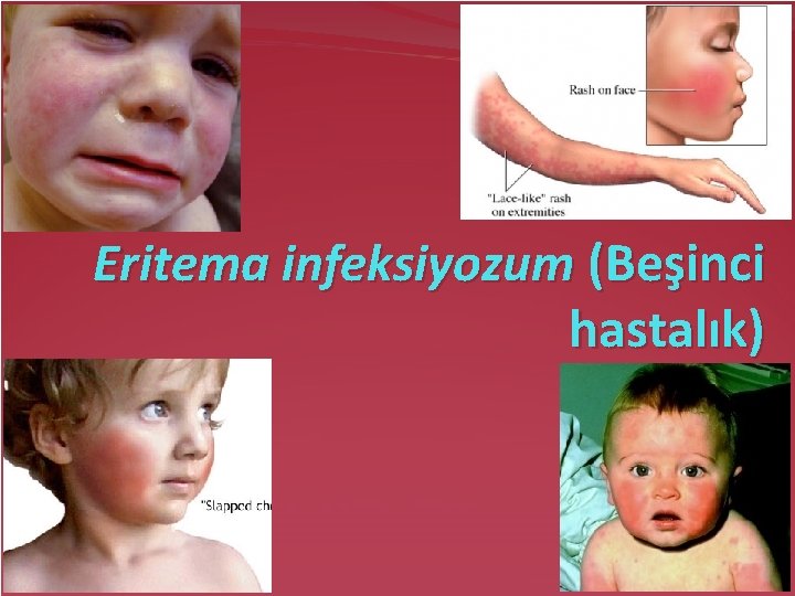 Eritema infeksiyozum (Beşinci hastalık) 