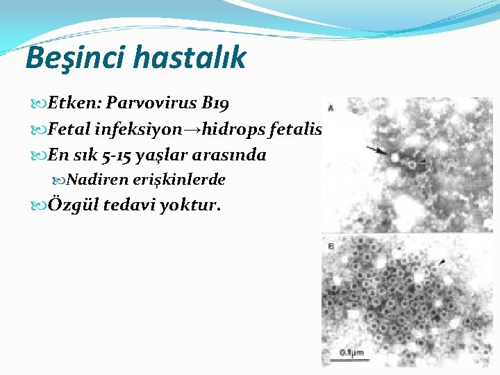 Beşinci hastalık Etken: Parvovirus B 19 Fetal infeksiyon→hidrops fetalis En sık 5 -15 yaşlar