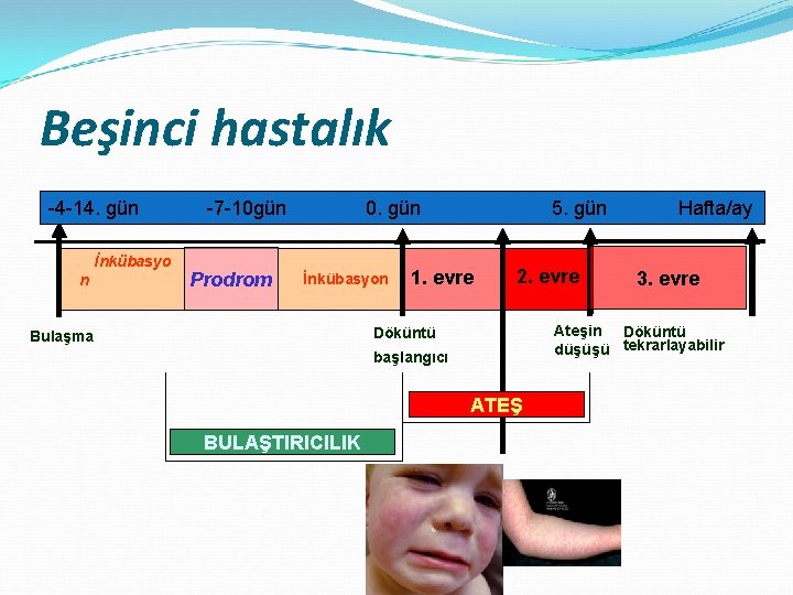 Beşinci hastalık -4 -14. gün İnkübasyo n -7 -10 gün Prodrom 0. gün İnkübasyon