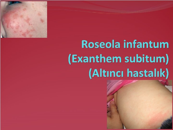 Roseola infantum (Exanthem subitum) (Altıncı hastalık) 