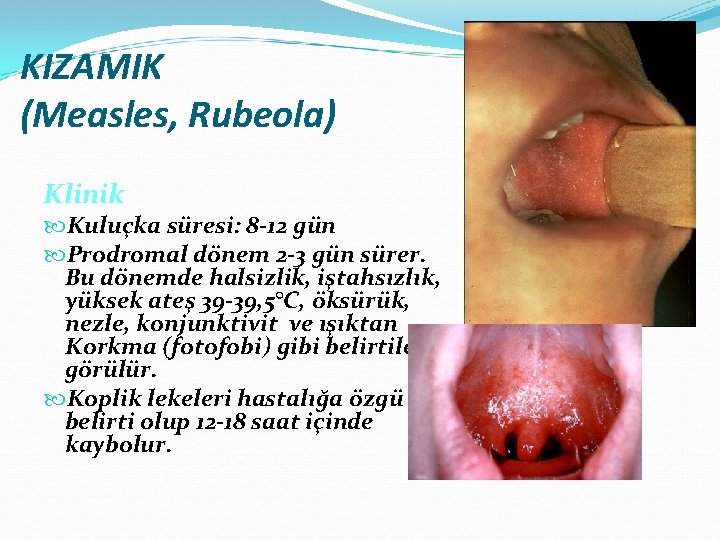 KIZAMIK (Measles, Rubeola) Klinik Kuluçka süresi: 8 -12 gün Prodromal dönem 2 -3 gün