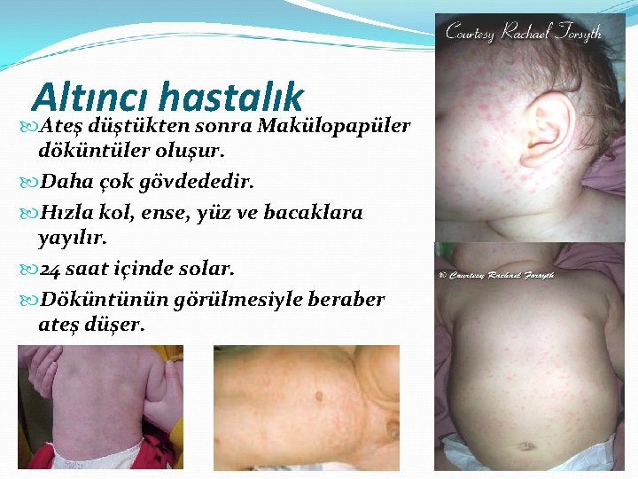 Altıncı hastalık Ateş düştükten sonra Makülopapüler döküntüler oluşur. Daha çok gövdededir. Hızla kol, ense,