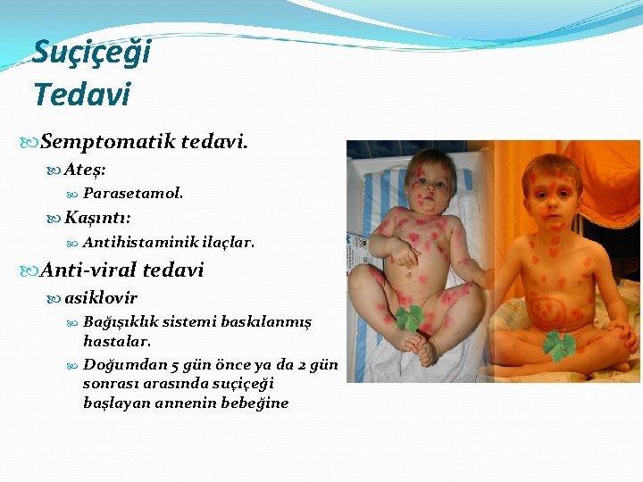 Suçiçeği Tedavi Semptomatik tedavi. Ateş: Parasetamol. Kaşıntı: Antihistaminik ilaçlar. Anti-viral tedavi asiklovir Bağışıklık sistemi