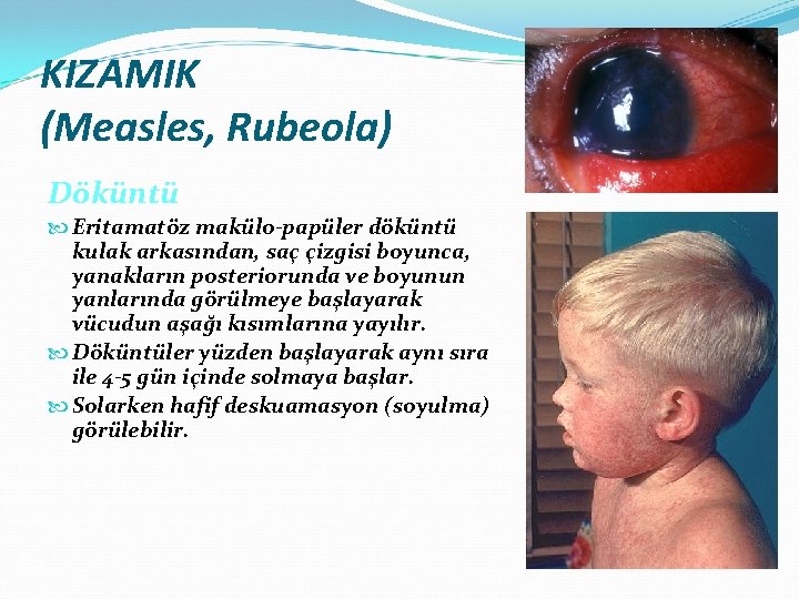 KIZAMIK (Measles, Rubeola) Döküntü Eritamatöz makülo-papüler döküntü kulak arkasından, saç çizgisi boyunca, yanakların posteriorunda