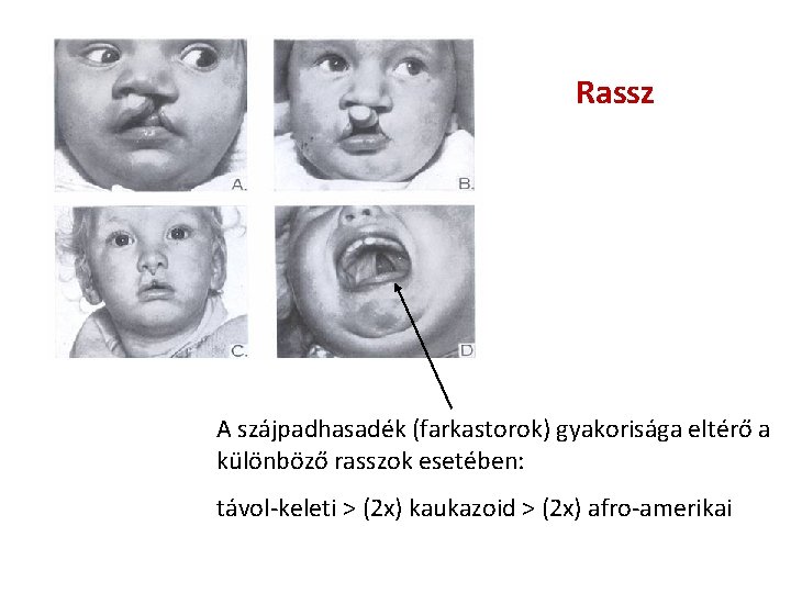 Rassz A szájpadhasadék (farkastorok) gyakorisága eltérő a különböző rasszok esetében: távol-keleti > (2 x) Rassz A szájpadhasadék (farkastorok) gyakorisága eltérő a különböző rasszok esetében: távol-keleti > (2 x)