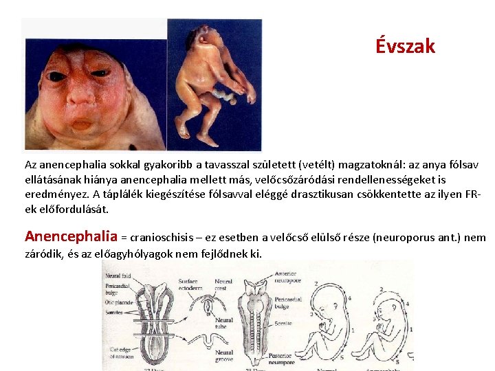 Évszak Az anencephalia sokkal gyakoribb a tavasszal született (vetélt) magzatoknál: az anya fólsav ellátásának