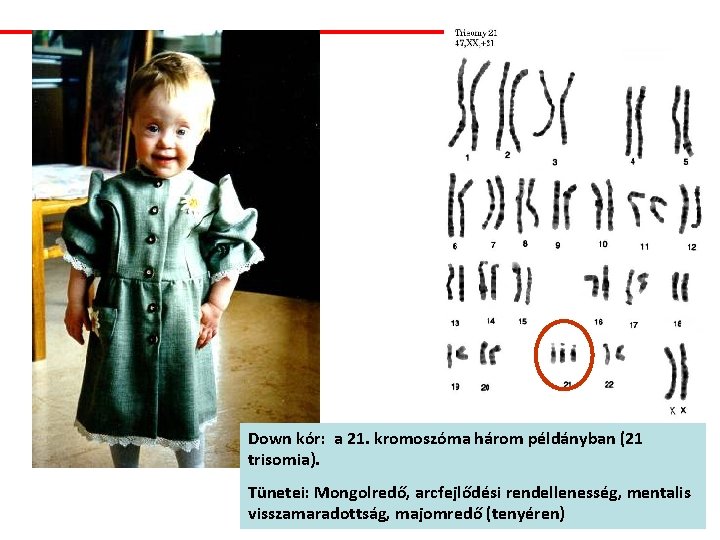 Down kór: a 21. kromoszóma három példányban (21 trisomia). Tünetei: Mongolredő, arcfejlődési rendellenesség, mentalis