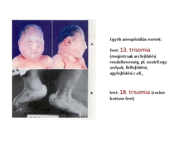 Egyéb aneuploidiás esetek: fent: 13. trisomia (megintcsak arcfejlődési rendellenesség, pl. nostril: egy orrlyuk, fülfejlődési, Egyéb aneuploidiás esetek: fent: 13. trisomia (megintcsak arcfejlődési rendellenesség, pl. nostril: egy orrlyuk, fülfejlődési,