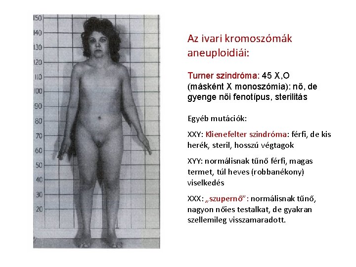 Az ivari kromoszómák aneuploidiái: Turner szindróma: 45 X, O (másként X monoszómia): nő, de