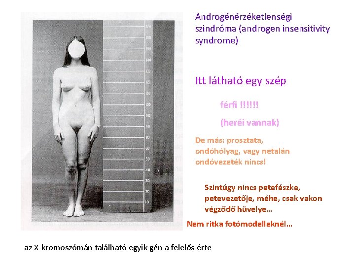 Androgénérzéketlenségi szindróma (androgen insensitivity syndrome) Itt látható egy szép férfi !!!!!! (heréi vannak) De