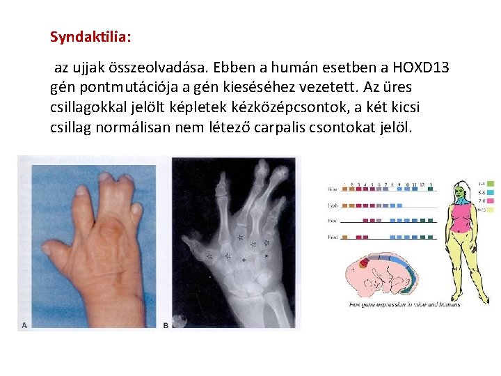 Syndaktilia: az ujjak összeolvadása. Ebben a humán esetben a HOXD 13 gén pontmutációja a