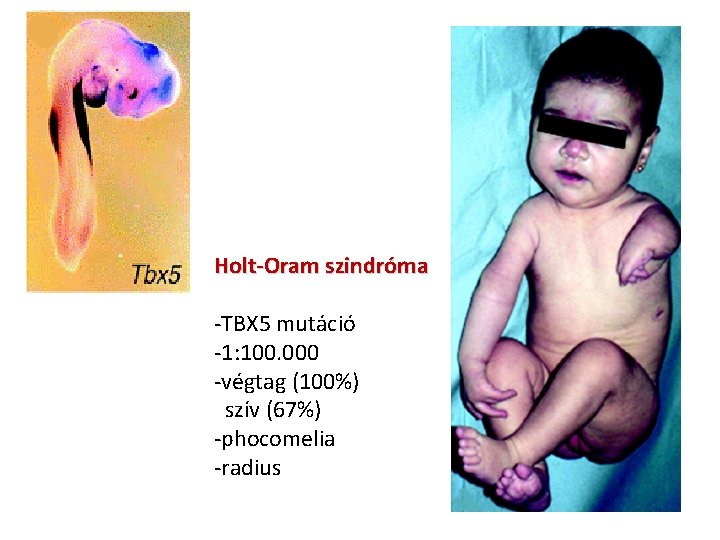 Holt-Oram szindróma -TBX 5 mutáció -1: 100. 000 -végtag (100%) szív (67%) -phocomelia -radius