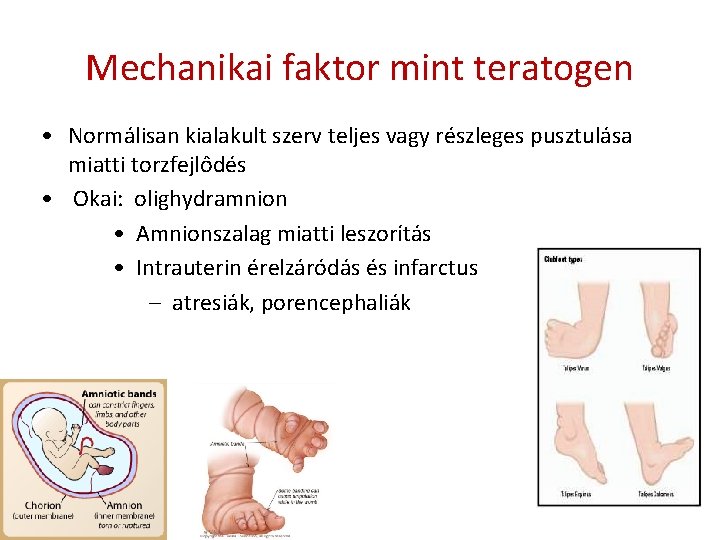 Mechanikai faktor mint teratogen • Normálisan kialakult szerv teljes vagy részleges pusztulása miatti torzfejlôdés