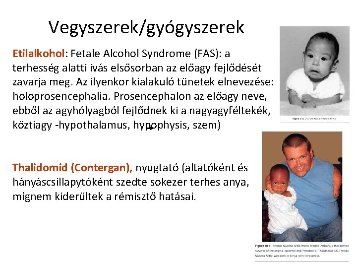 Vegyszerek/gyógyszerek Etilalkohol: Fetale Alcohol Syndrome (FAS): a terhesség alatti ivás elsősorban az előagy fejlődését