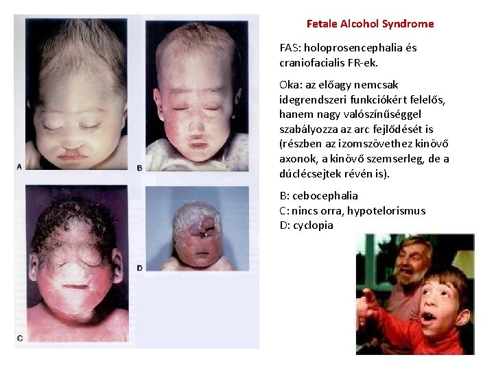 Fetale Alcohol Syndrome FAS: holoprosencephalia és craniofacialis FR-ek. Oka: az előagy nemcsak idegrendszeri funkciókért Fetale Alcohol Syndrome FAS: holoprosencephalia és craniofacialis FR-ek. Oka: az előagy nemcsak idegrendszeri funkciókért