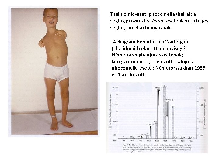 Thalidomid-eset: phocomelia (balra): a végtag proximális részei (esetenként a teljes végtag: amelia) hiányoznak. A