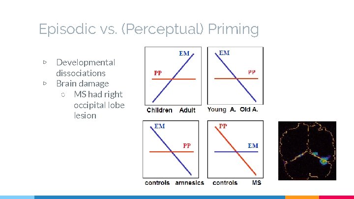 Episodic vs. (Perceptual) Priming ▷ ▷ Developmental dissociations Brain damage ○ MS had right