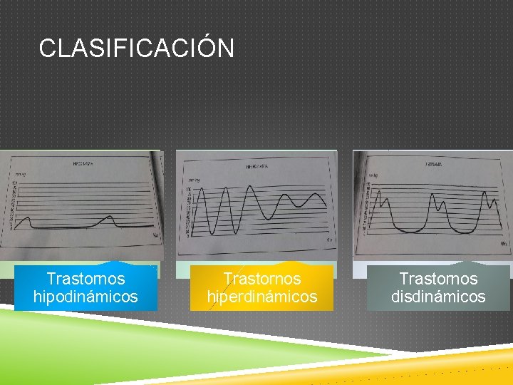 CLASIFICACIÓN Trastornos hipodinámicos Trastornos hiperdinámicos Trastornos disdinámicos 