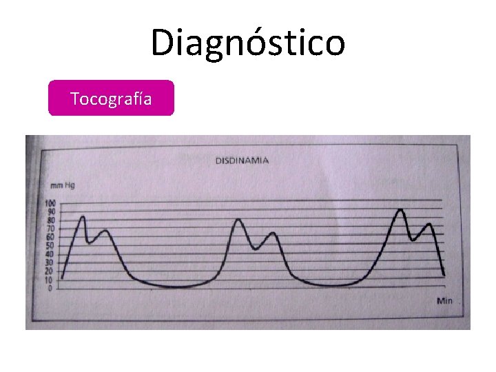 Diagnóstico Tocografía 