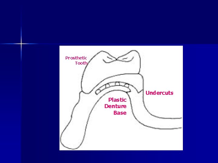 Prosthetic Tooth Undercuts Plastic Denture Base 