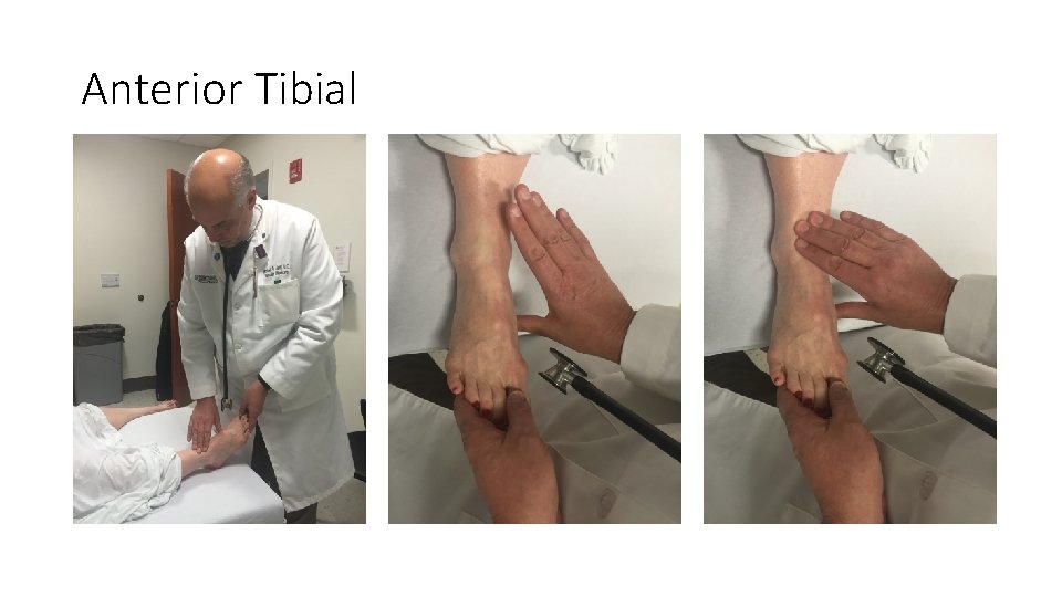 Anterior Tibial Anterior Tibial