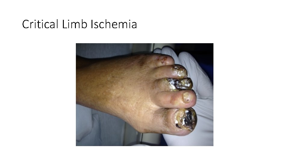 Critical Limb Ischemia Critical Limb Ischemia