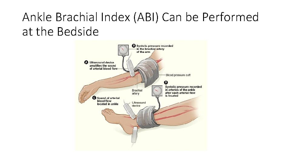 Ankle Brachial Index (ABI) Can be Performed at the Bedside Ankle Brachial Index (ABI) Can be Performed at the Bedside