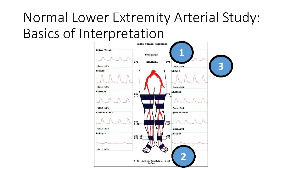 Normal Lower Extremity Arterial Study: Basics of Interpretation 1 2 3 Normal Lower Extremity Arterial Study: Basics of Interpretation 1 2 3