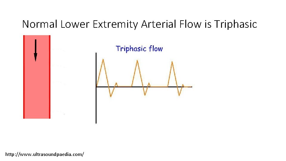 Normal Lower Extremity Arterial Flow is Triphasic http: //www. ultrasoundpaedia. com/ Normal Lower Extremity Arterial Flow is Triphasic http: //www. ultrasoundpaedia. com/