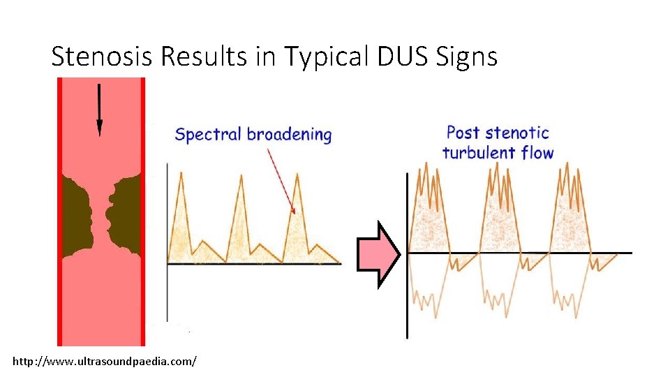 Stenosis Results in Typical DUS Signs http: //www. ultrasoundpaedia. com/ Stenosis Results in Typical DUS Signs http: //www. ultrasoundpaedia. com/