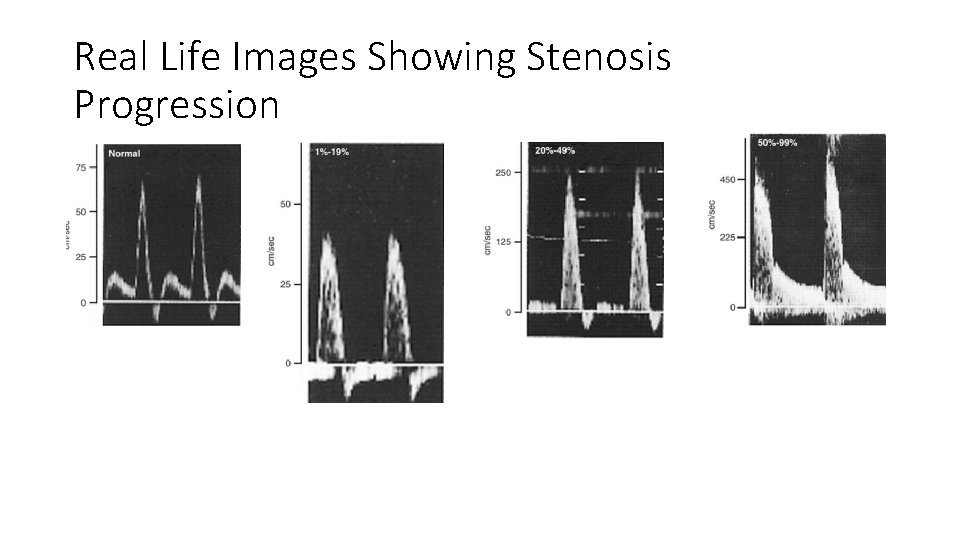 Real Life Images Showing Stenosis Progression Real Life Images Showing Stenosis Progression