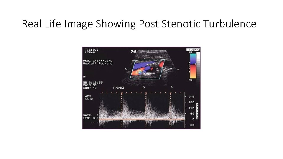 Real Life Image Showing Post Stenotic Turbulence Real Life Image Showing Post Stenotic Turbulence