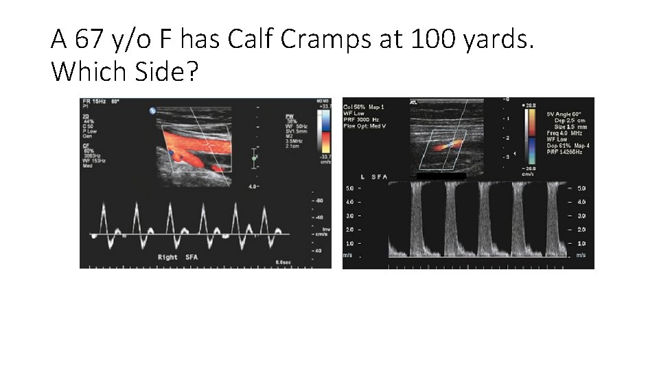 A 67 y/o F has Calf Cramps at 100 yards. Which Side? A 67 y/o F has Calf Cramps at 100 yards. Which Side?