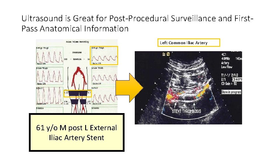 Ultrasound is Great for Post-Procedural Surveillance and First. Pass Anatomical Information Left Common Iliac Ultrasound is Great for Post-Procedural Surveillance and First. Pass Anatomical Information Left Common Iliac