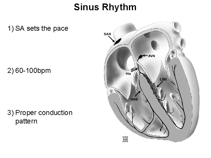 Sinus Rhythm 1) SA sets the pace 2) 60 -100 bpm 3) Proper conduction