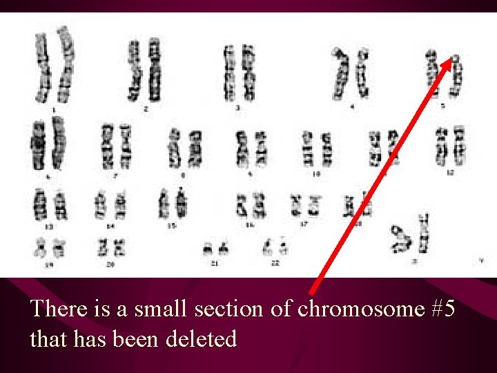 There is a small section of chromosome #5 that has been deleted 