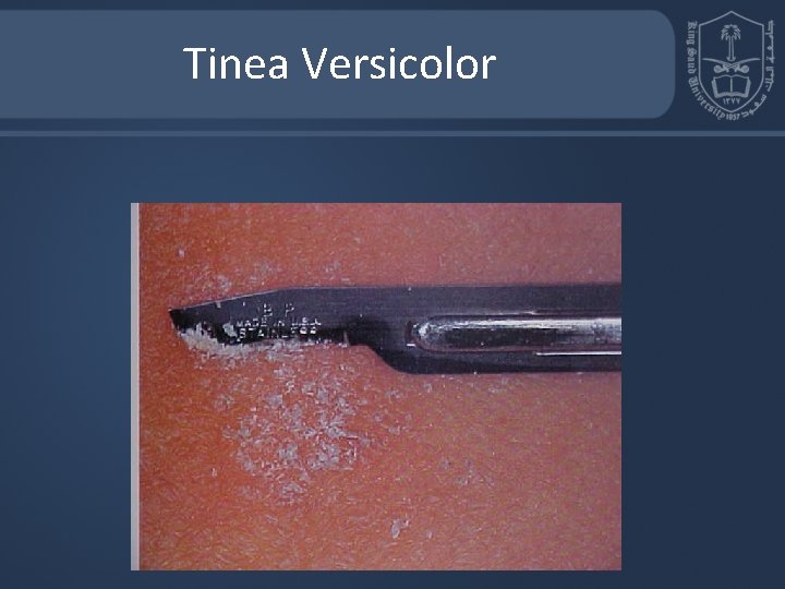 Tinea Versicolor 