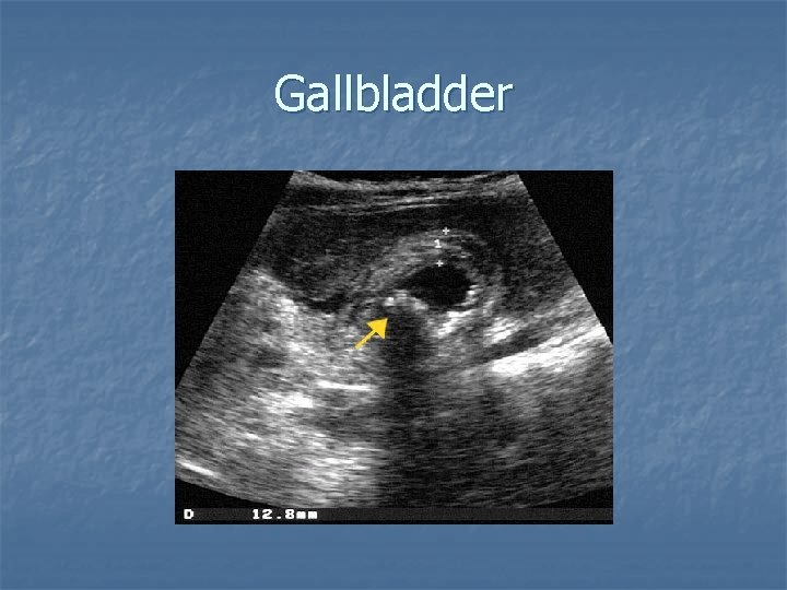 Gallbladder 