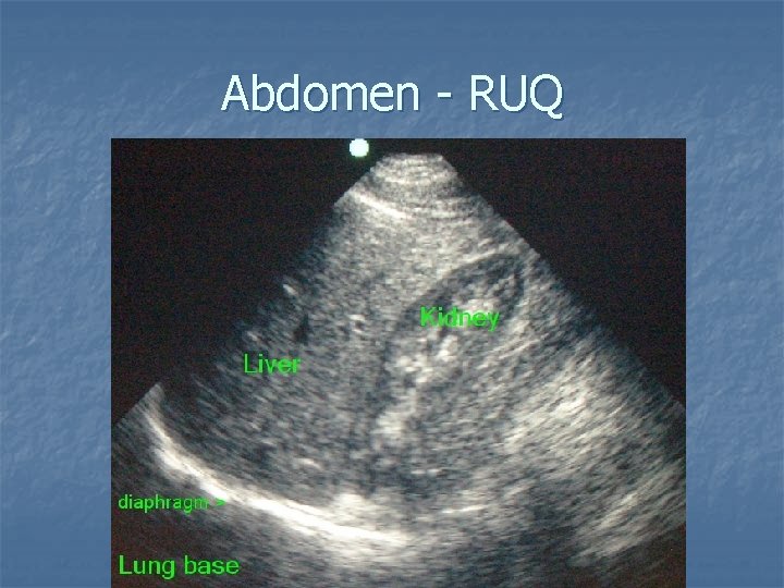 Abdomen - RUQ 