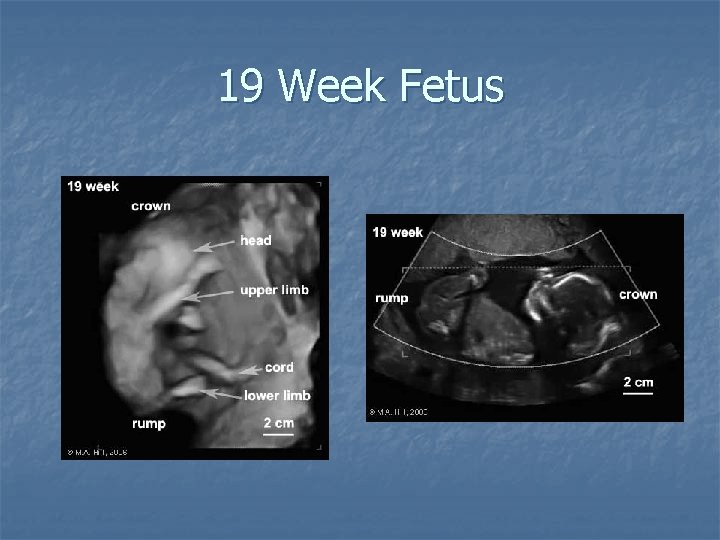 19 Week Fetus 