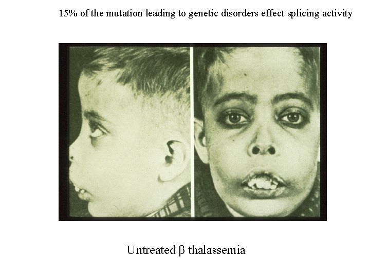 15% of the mutation leading to genetic disorders effect splicing activity Untreated β thalassemia 15% of the mutation leading to genetic disorders effect splicing activity Untreated β thalassemia