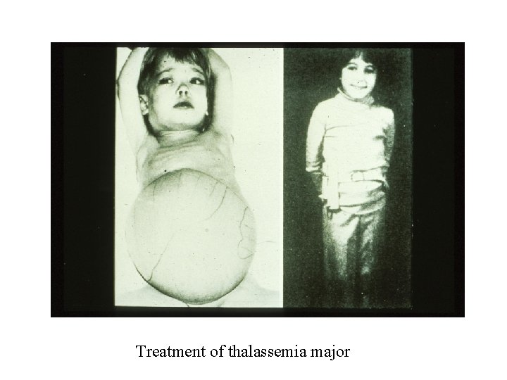 Treatment of thalassemia major Treatment of thalassemia major