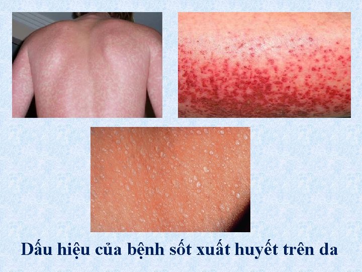 Dấu hiệu của bệnh sốt xuất huyết trên da 