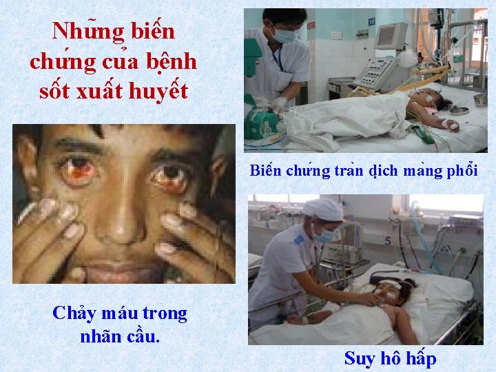 Như ng biê n chư ng cu a bê nh sô t xuâ t