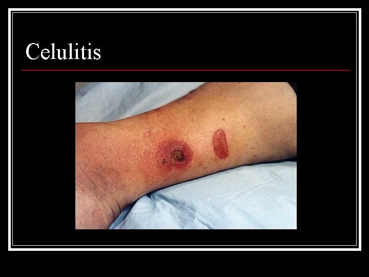 Celulitis 