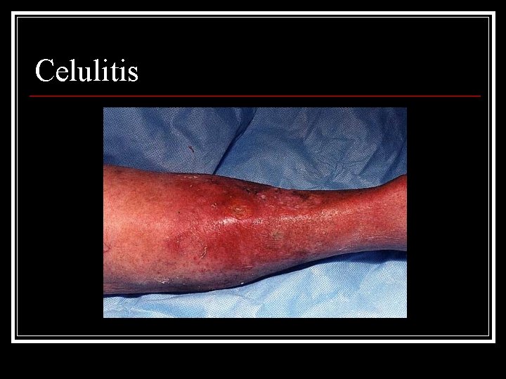 Celulitis 