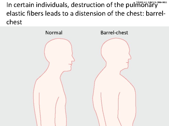 In certain individuals, destruction of the pulmonary elastic fibers leads to a distension of