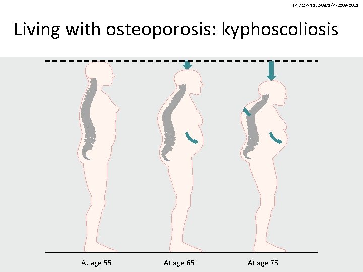 TÁMOP-4. 1. 2 -08/1/A-2009 -0011 Living with osteoporosis: kyphoscoliosis At age 55 At age