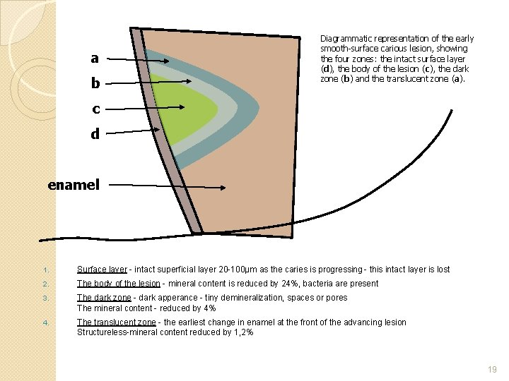 a b Diagrammatic representation of the early smooth-surface carious lesion, showing the four zones: