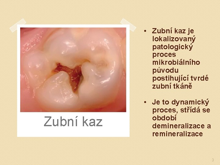  • Zubní kaz je lokalizovaný patologický proces mikrobiálního původu postihující tvrdé zubní tkáně